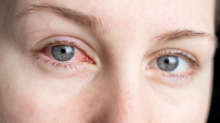 bakterija Chlamydia pneumoniae, poznata kao uzročnik upala sinusa i pluća, može se zadržati u oku godinama - i pritom potencijalno povećati rizik od Alzheimerove bolesti