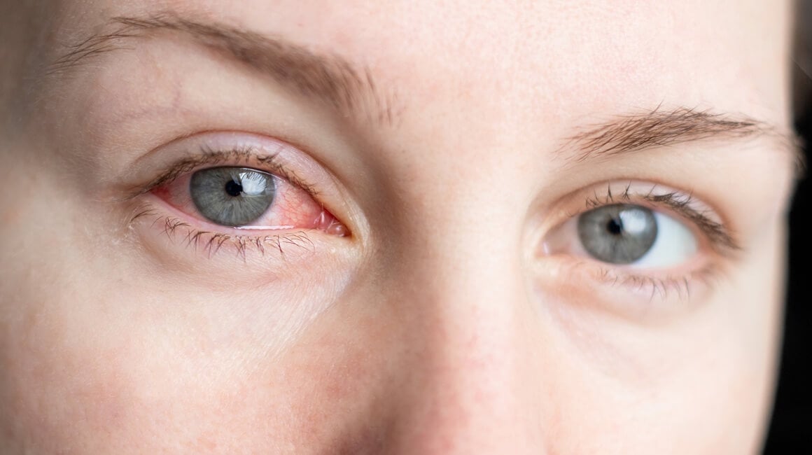 bakterija Chlamydia pneumoniae, poznata kao uzročnik upala sinusa i pluća, može se zadržati u oku godinama - i pritom potencijalno povećati rizik od Alzheimerove bolesti