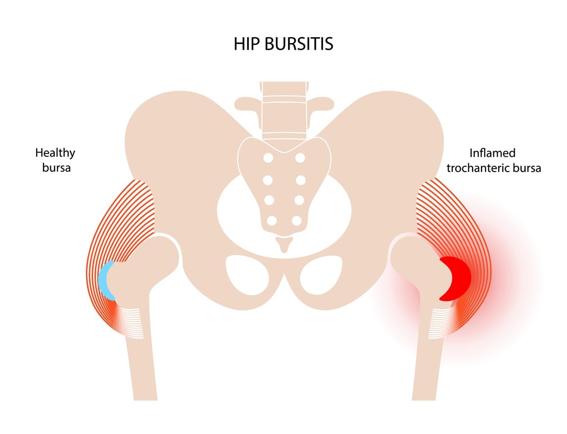 bol u preponama i kukovima
