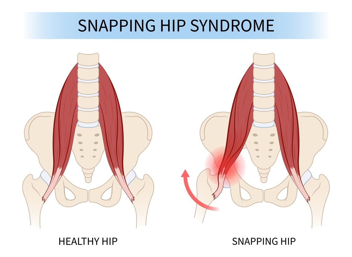 bolovi u kuku i preponama