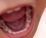 djeca s čestim karijesima ili izraženom upalom desni (gingivitisom) kasnije u životu imaju znatno veći rizik od srčanog udara, moždanog udara i začepljenja arterija