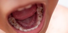djeca s čestim karijesima ili izraženom upalom desni (gingivitisom) kasnije u životu imaju znatno veći rizik od srčanog udara, moždanog udara i začepljenja arterija