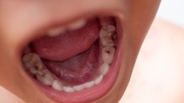 djeca s čestim karijesima ili izraženom upalom desni (gingivitisom) kasnije u životu imaju znatno veći rizik od srčanog udara, moždanog udara i začepljenja arterija