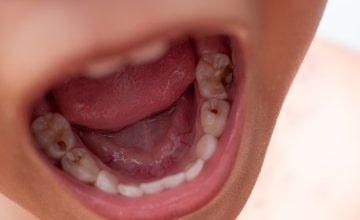 djeca s čestim karijesima ili izraženom upalom desni (gingivitisom) kasnije u životu imaju znatno veći rizik od srčanog udara, moždanog udara i začepljenja arterija