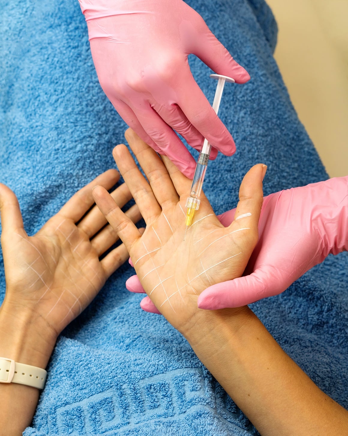 hiperhidroza dlanova i botoks