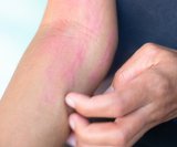 kronična spontana urtikarija