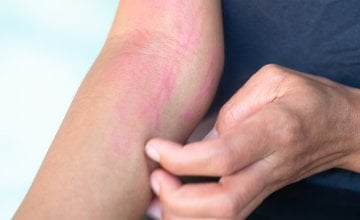 kronična spontana urtikarija