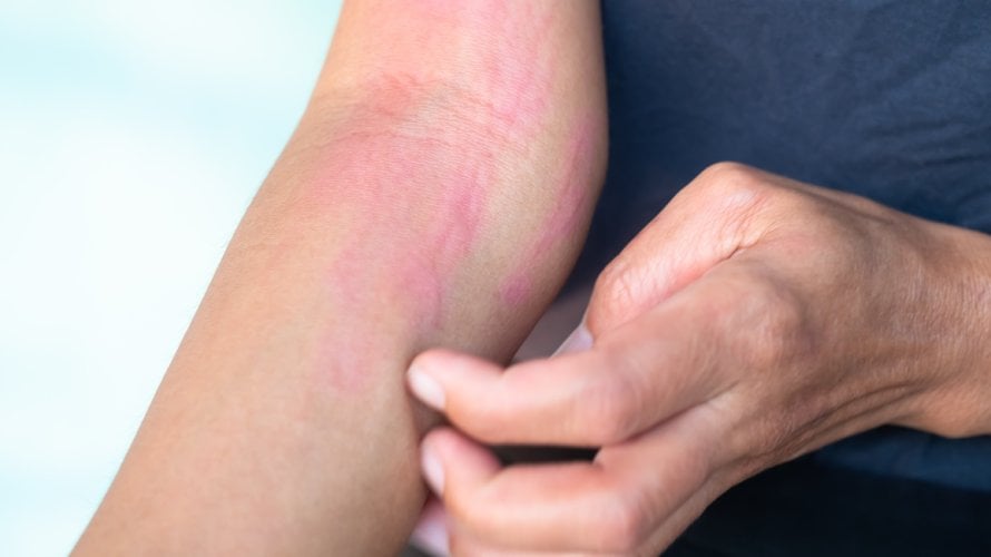 kronična spontana urtikarija