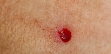 krvarenje madeža ili kožnih promjena - osobito ako je praćeno bolom, svrbežom ili iritacijom - ponekad može biti znak raka kože