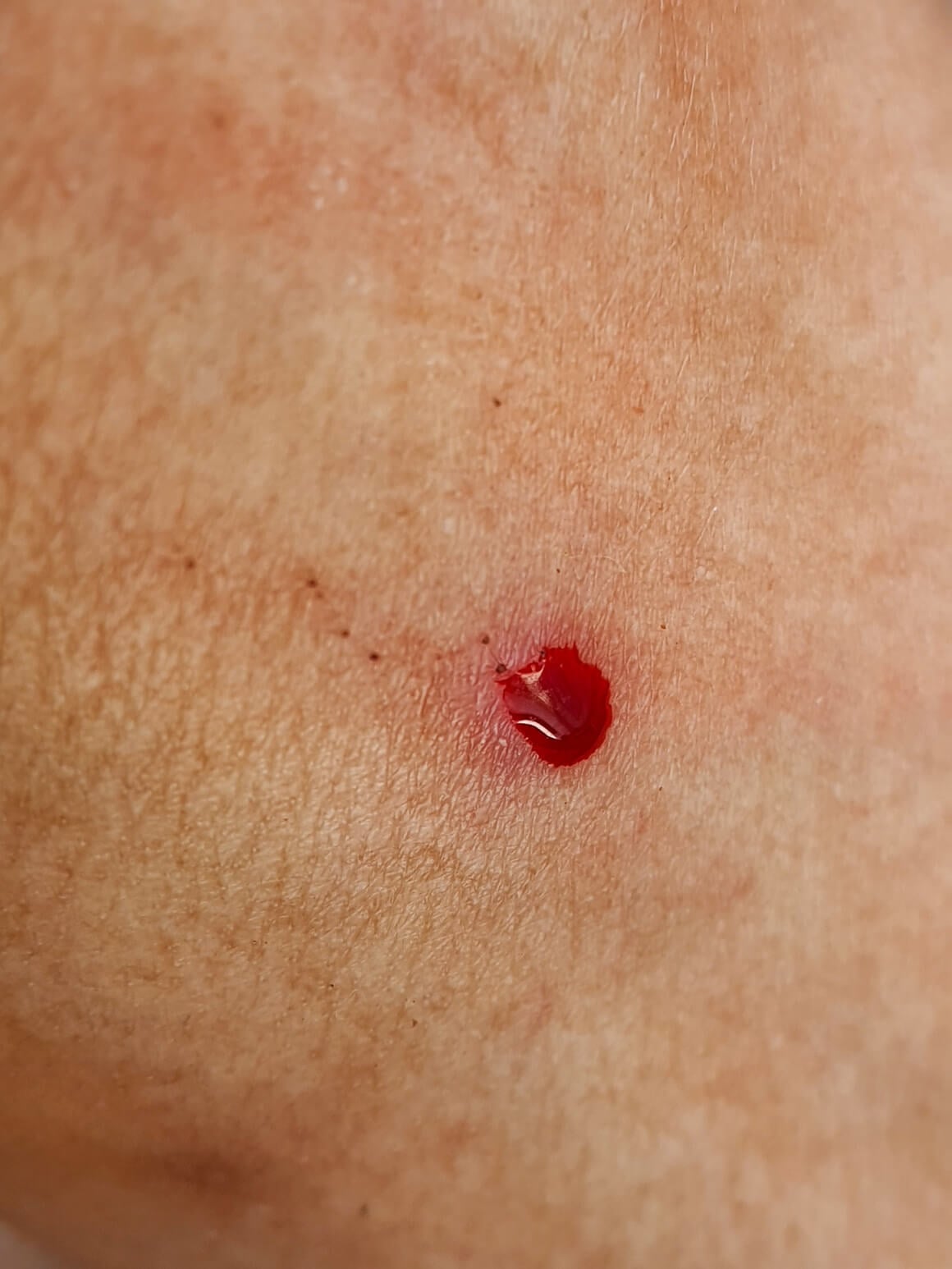 krvarenje madeža ili kožnih promjena - osobito ako je praćeno bolom, svrbežom ili iritacijom - ponekad može biti znak raka kože