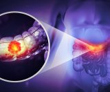 rak debelog i završnog crijeva sve češće pogađa mlađe osobe