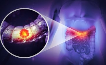 rak debelog i završnog crijeva sve češće pogađa mlađe osobe