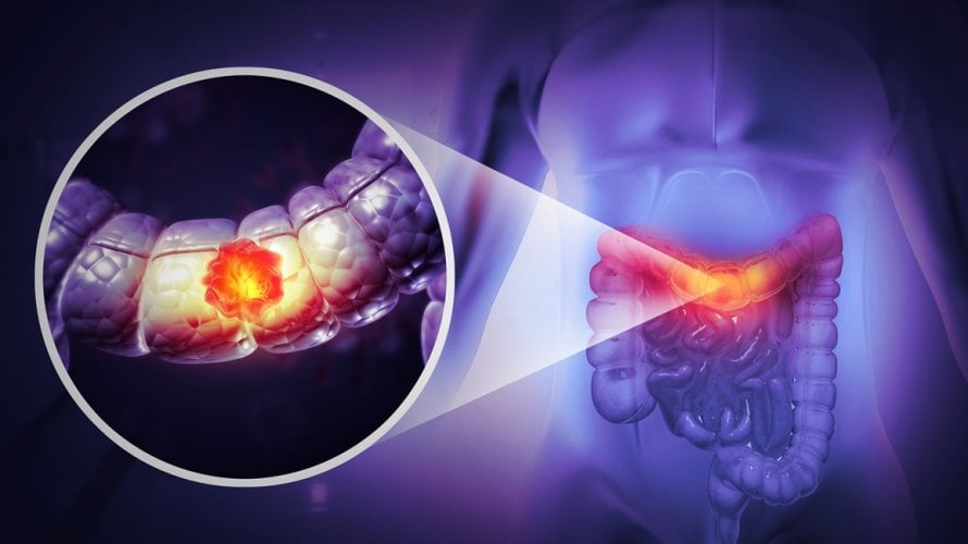 rak debelog i završnog crijeva sve češće pogađa mlađe osobe
