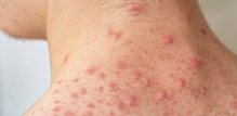 Acne mechanica mogu se pojaviti na licu i tijelu - najčešće na leđima, ramenima, stražnjici ili bedrima