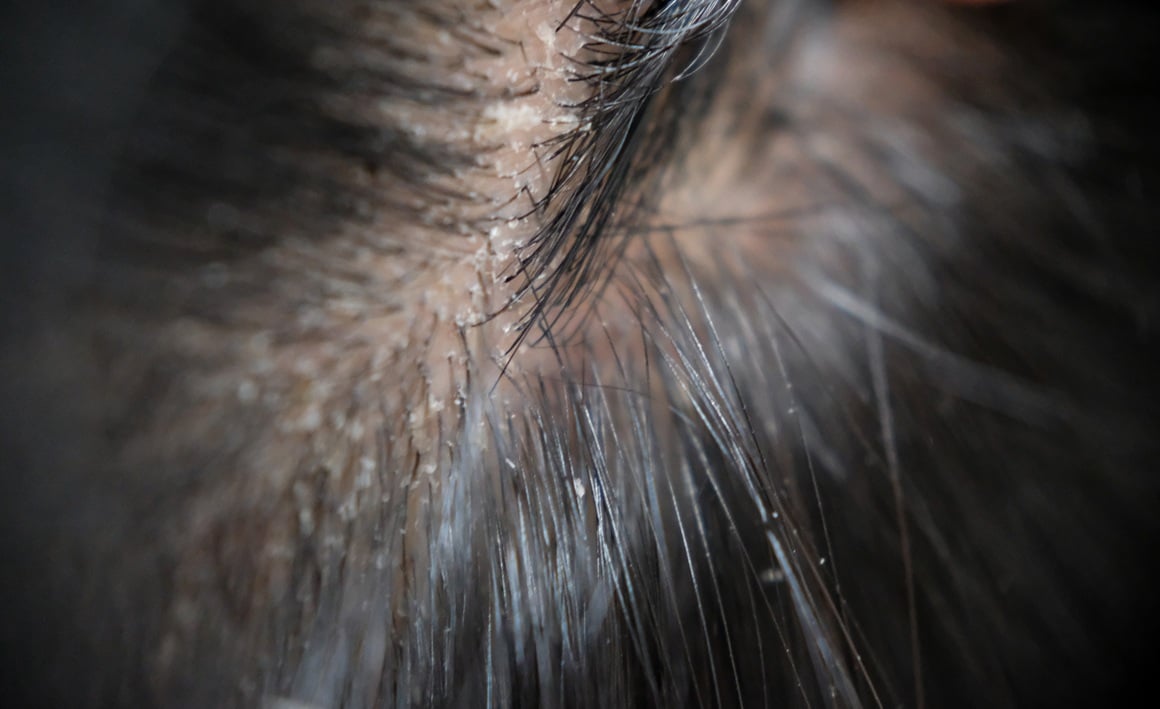 Ako kosu ne perete tjedan ili dva, mogu se pojaviti bijele ljuskice - perut