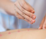 Akupunktura se već koristi za ublažavanje bolova kod osteoartritisa, a neki vjeruju da može pomoći i kod bolova u mišićima i zglobovima povezanih s lupusom