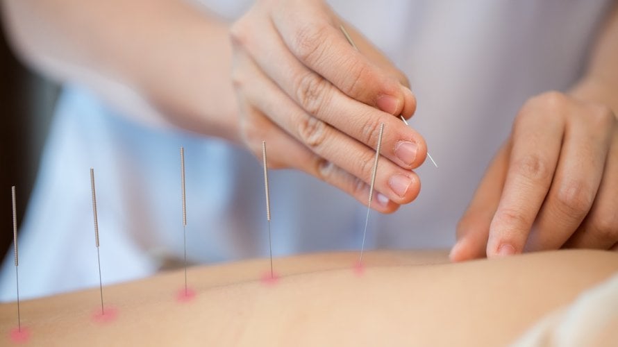 Akupunktura se već koristi za ublažavanje bolova kod osteoartritisa, a neki vjeruju da može pomoći i kod bolova u mišićima i zglobovima povezanih s lupusom