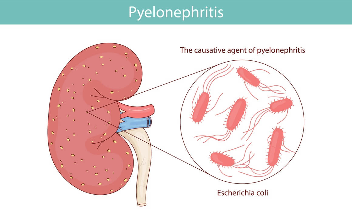 Bakterija koja napada bubrege
