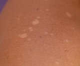 Bijele mrlje na koži