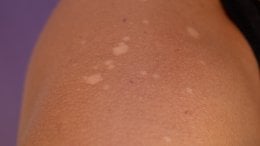 Bijele mrlje na koži