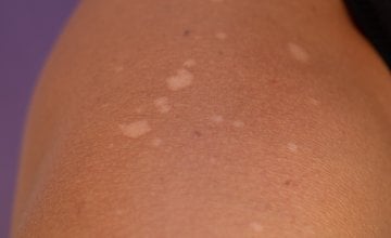 Bijele mrlje na koži
