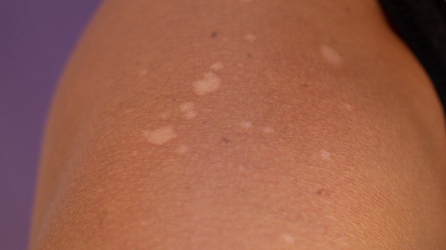 Bijele mrlje na koži
