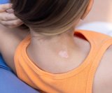 Bijele pjege od sunca