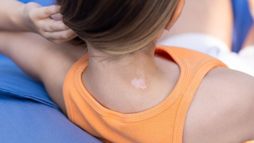 Bijele pjege od sunca