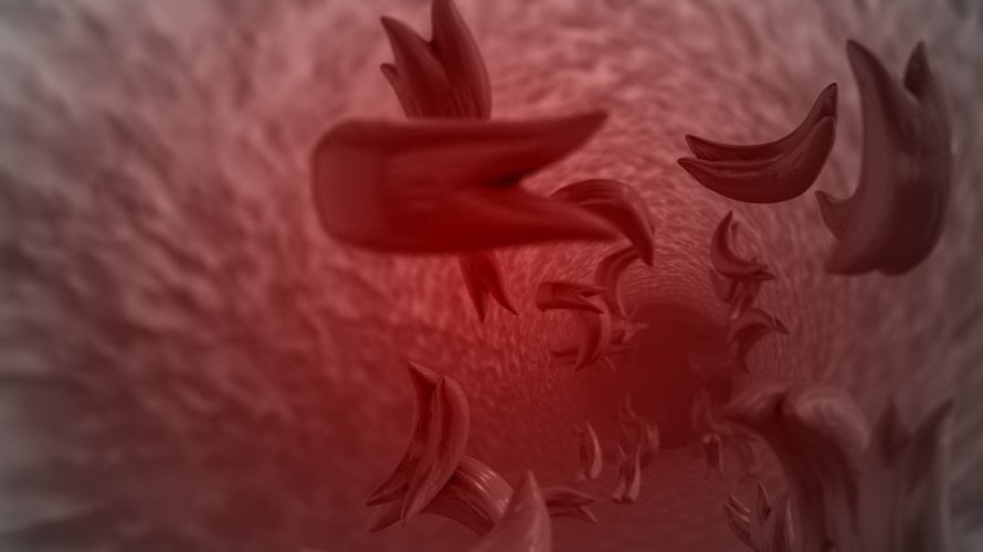 Bol je jedan od najčešćih i najtežih simptoma bolesti srpastih stanica