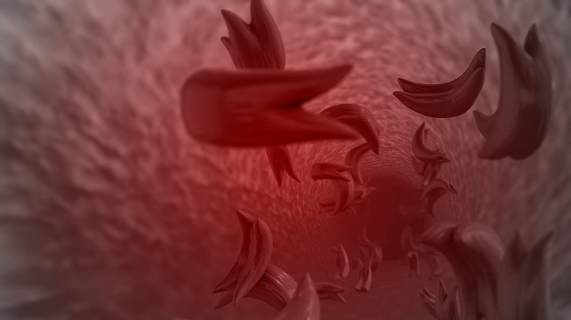 Bol je jedan od najčešćih i najtežih simptoma bolesti srpastih stanica