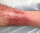 Celulitis - simptomi