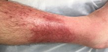 Celulitis - simptomi