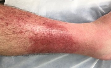 Celulitis - simptomi