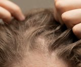 Dugotrajno izbjegavanje pranja kose može uzrokovati neugodan svrbež i nadraženost