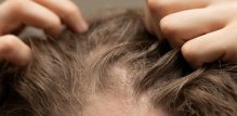 Dugotrajno izbjegavanje pranja kose može uzrokovati neugodan svrbež i nadraženost
