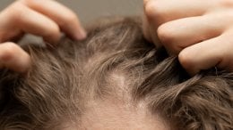 Dugotrajno izbjegavanje pranja kose može uzrokovati neugodan svrbež i nadraženost