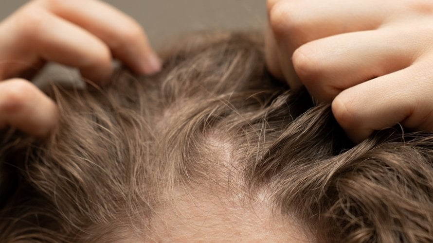 Dugotrajno izbjegavanje pranja kose može uzrokovati neugodan svrbež i nadraženost