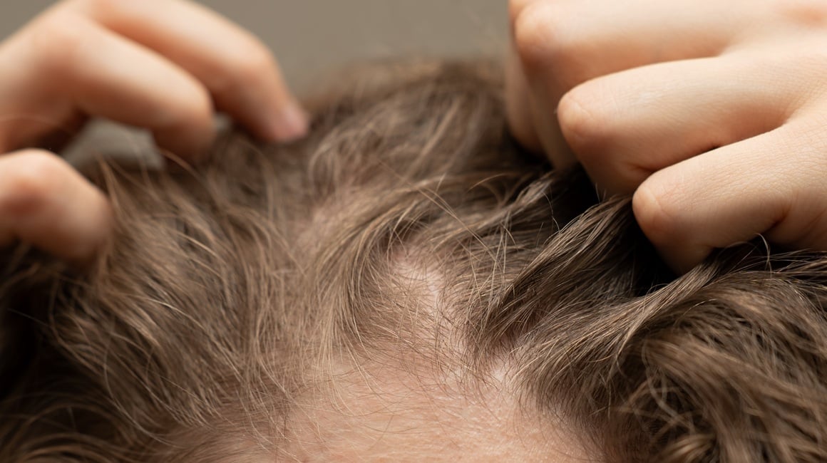 Dugotrajno izbjegavanje pranja kose može uzrokovati neugodan svrbež i nadraženost