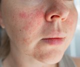 Ekcem, poznat i kao atopijski dermatitis, kronično je upalno stanje kože koje uzrokuje suhoću, svrbež, osipe i mjehuriće