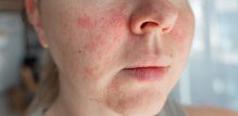 Ekcem, poznat i kao atopijski dermatitis, kronično je upalno stanje kože koje uzrokuje suhoću, svrbež, osipe i mjehuriće