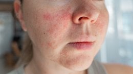 Ekcem, poznat i kao atopijski dermatitis, kronično je upalno stanje kože koje uzrokuje suhoću, svrbež, osipe i mjehuriće