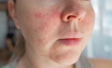 Ekcem, poznat i kao atopijski dermatitis, kronično je upalno stanje kože koje uzrokuje suhoću, svrbež, osipe i mjehuriće