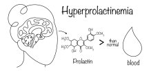 Hiperprolaktinemija - simptomi