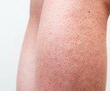 Kako ublažiti iritaciju kože nakon brijanja