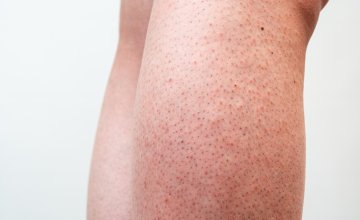 Kako ublažiti iritaciju kože nakon brijanja