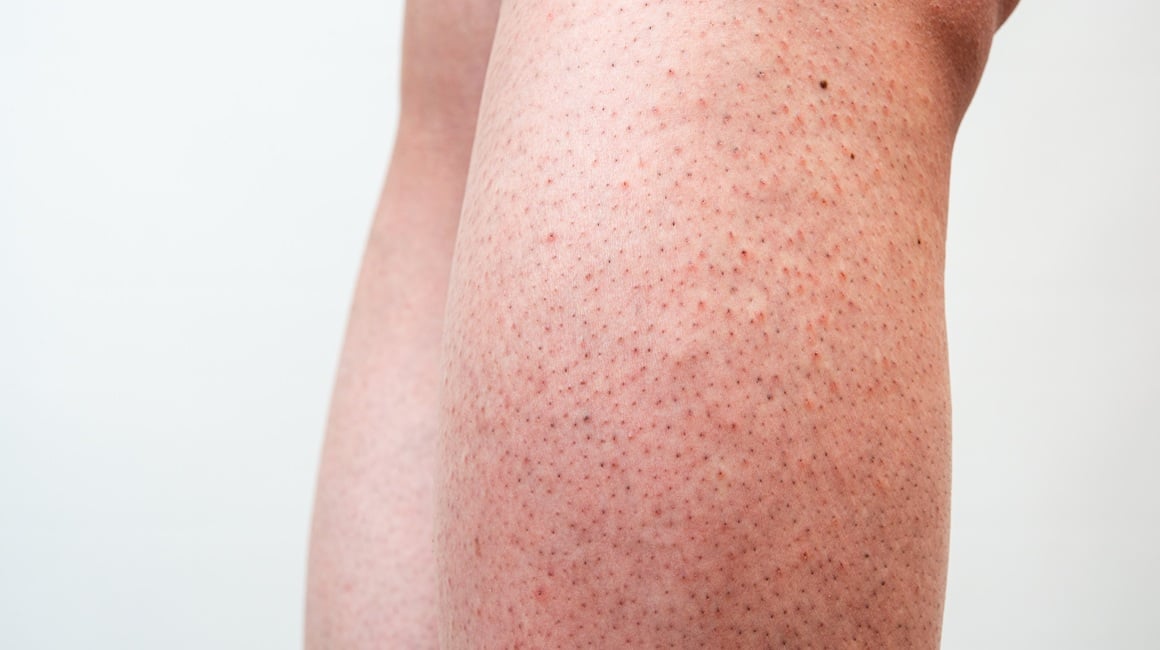 Kako ublažiti iritaciju kože nakon brijanja