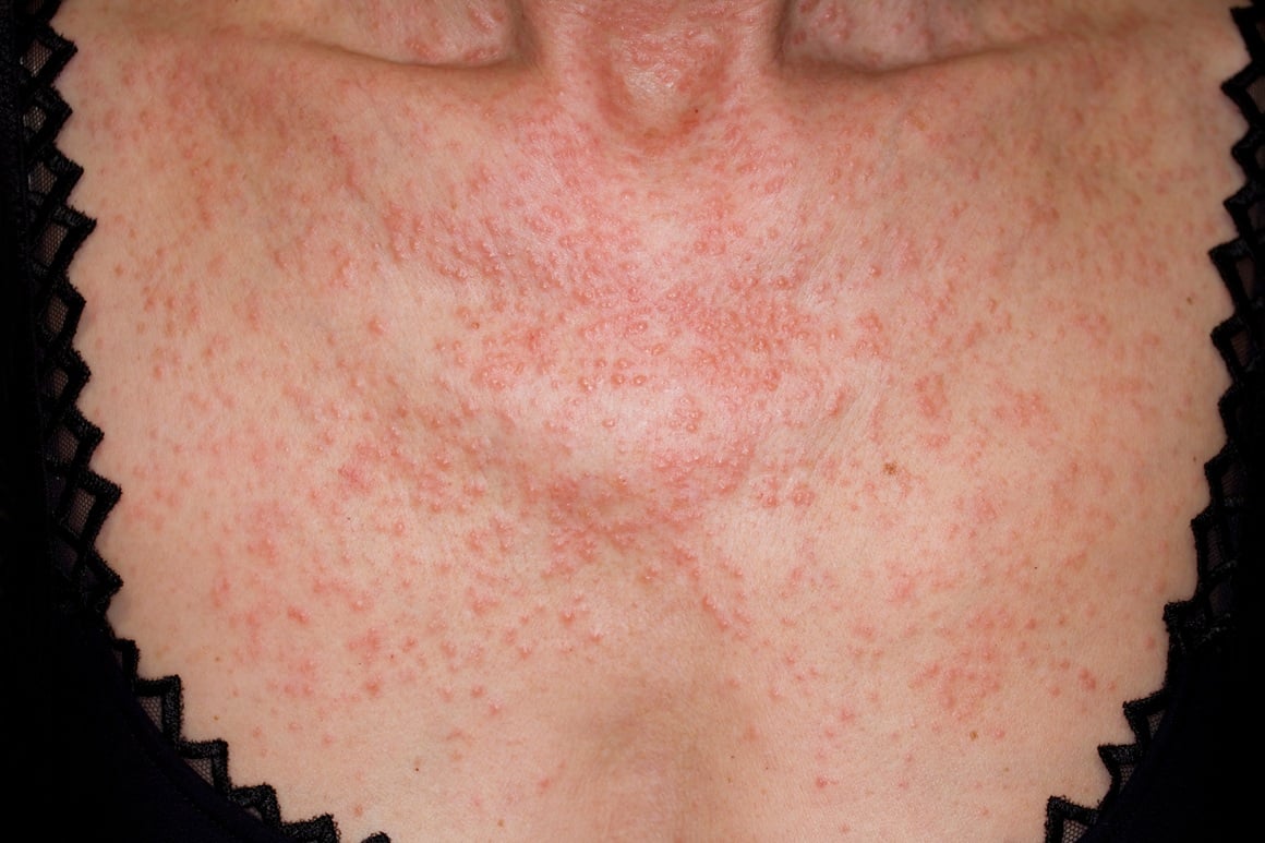 Keto osip (lat. prurigo pigmentosa) je rijetka upalna bolest kože koja se povezuje s ketozom