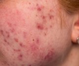 Kortikosteroidi i akne