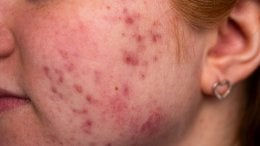 Kortikosteroidi i akne