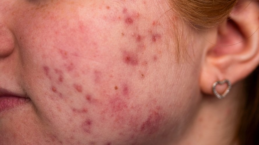 Kortikosteroidi i akne